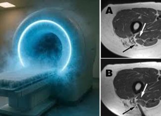 MRI-Guided Cryoablation: A “No-Cut” Approach to Destroying Cancer